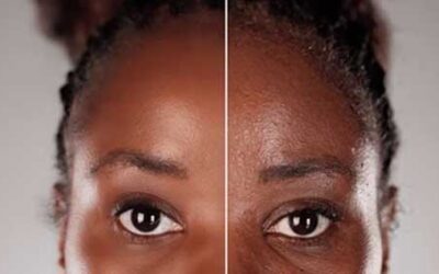 How Jane Restored Her Skin Naturally with Kakie’s Herbal Cleanser