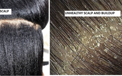 How to Maintain a Clean, Healthy Scalp: Choosing the Right Shampoo for Dandruff and Hair Care