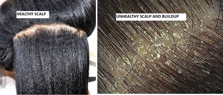 SCALP AND BUILD UP How to Maintain a Clean, Healthy Scalp